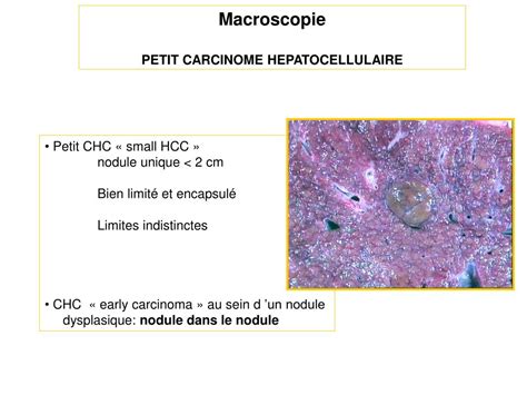 Ppt Carcinome H Patocellulaire Aspects Anatomopathologiques Amir