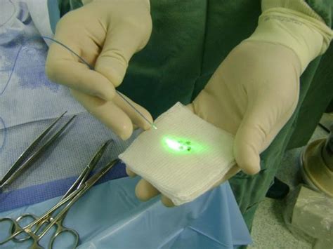 LASER para tratamento de cálculos urinários