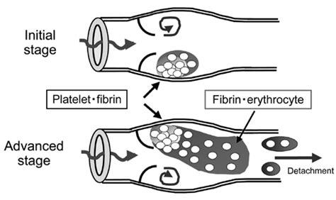 Mechanism of venous thrombus formation. | Download Scientific Diagram