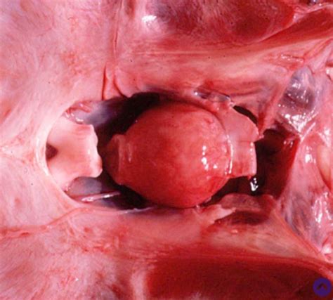 TD 07 QUIZ Pathologie Des Glandes Endocrines Cartes Quizlet