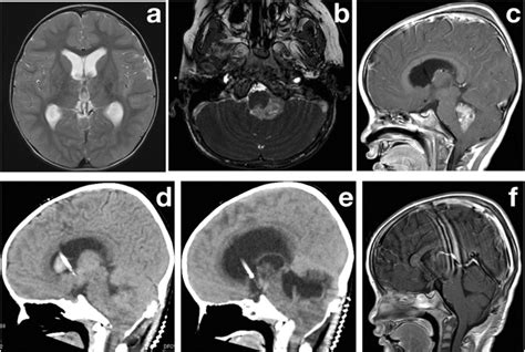 A Initial Axial T2 Weighted Magnetic Resonance Image Shows Moderate