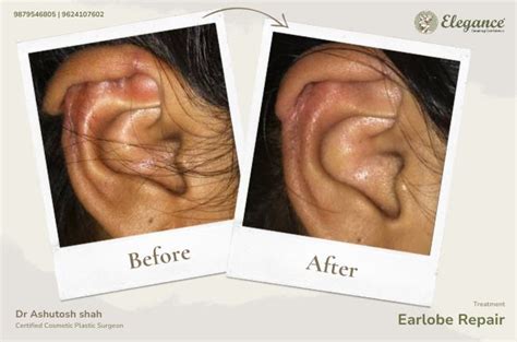 Otoplasty Earlobe Repair Elegance Clinic