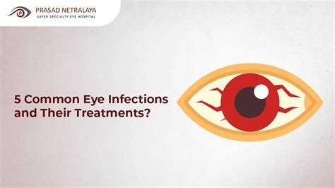 5 Common Eye Infections And Their Treatments Prasad Netralaya