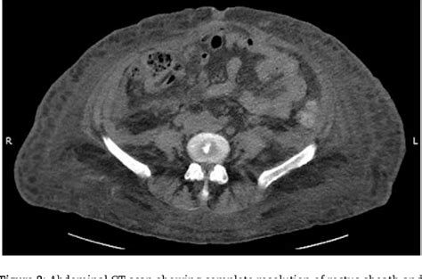 Figure From Abdominal Compartment Syndrome Due To Spontaneous Rectus