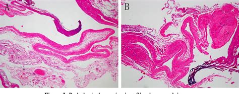 Figure 1 From Parapelvic Cyst Causing Ureteropelvic Junction Stricture