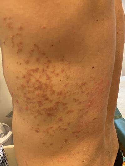 Methyl Isobutyl Ketone Skin Rash