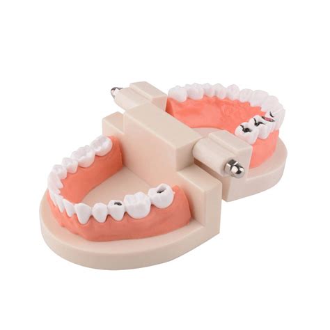 Ultrassist Dental Caries Study Model Life Size Fake Adult Dental