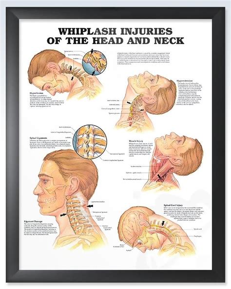 This 20x26 Inch Exam Room Human Anatomy Poster Defines Whiplash