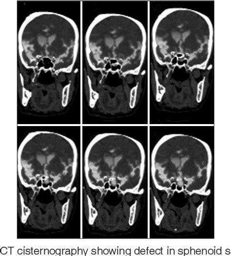 Figure 1 From Endoscopic Management Of Cerebrospinal Fluid Rhinorrhea Semantic Scholar