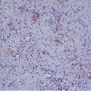 Representative Immunohistochemical Staining Images Of INSR IRS 1 And