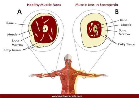 Sarcopenia - Causes, Symptoms, Management - Medhya Herbals