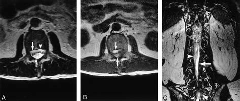 Spinal Subdural Hematoma