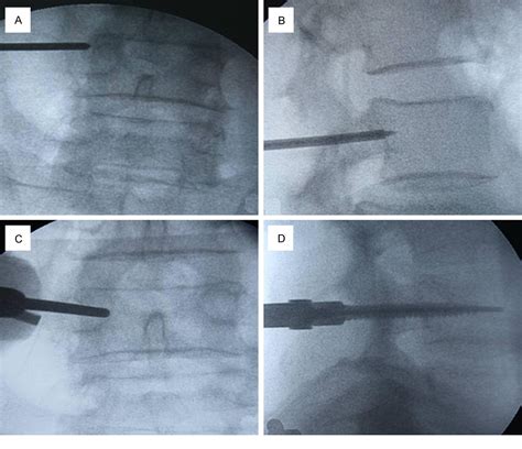 Figure From A Minimally Invasive Posterior Lumbar Interbody Fusion