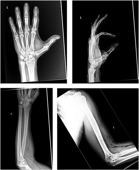 X Rays Of Left Hand Wrist Forearm And Humerus Showing Extensive