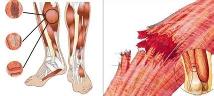 Rotura Muscular Que Es Y Como Se Diagnostica Correctamente