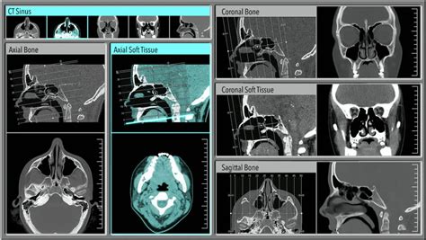 Tout Savoir Sur Le Scanner Des Sinus