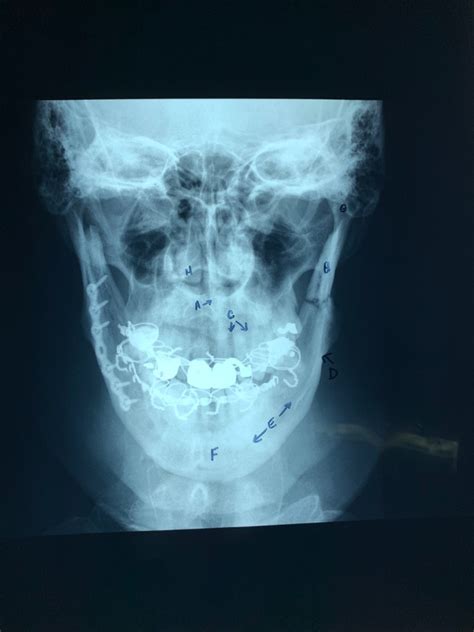 Pa Projection Mandible Diagram Quizlet