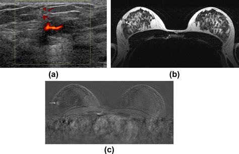 Fibromatosis Of The Breast A Pictorial Review Of The Imaging And Histopathology Findings