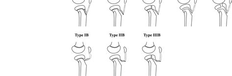 Anterior Tibial Tuberosity