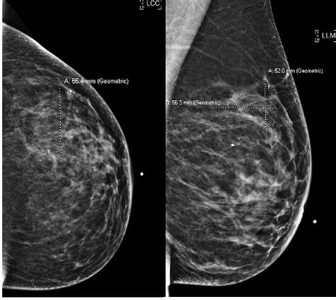 Invasive Ductal Carcinoma Mammogram