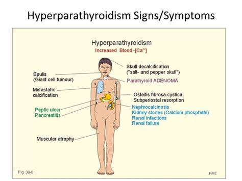 Symptoms Of Hyperparathyroidism Cancer Care Center Uae