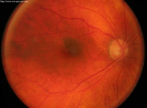 OCT angiography & Nevus & Melanoma