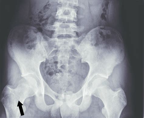 Rradiography Of The Pelvis Showed Focal Osteolytic Lesions In The