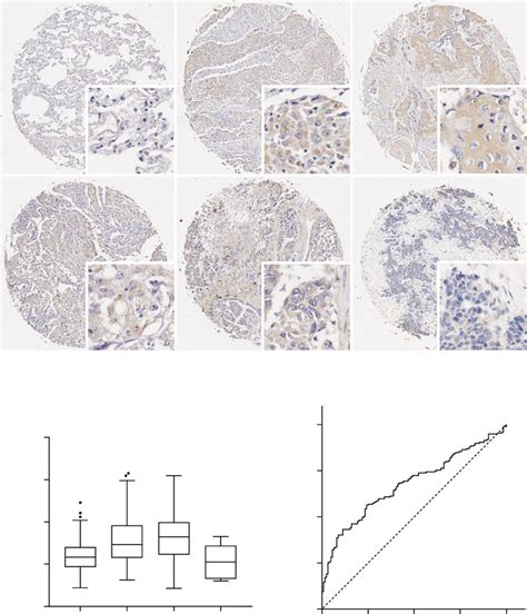 Prongf Expression In Lung Cancers And Normal Tissues A F