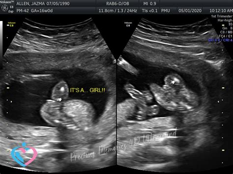 Pregnancy Ultrasound Image Gallery - 10 - 16 Weeks