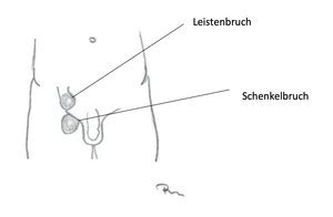 Leistenhernie Chirurgie Am Stadtgarten Ettlingen