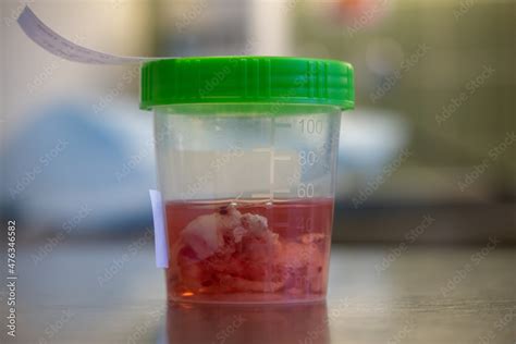 Tissue Sample Is Placed In A Formalin Filled Cup After An Operation