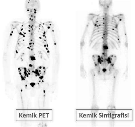 PROSTAT KANSERİ VE PSMA PET BT Prof Dr Serkan Kuyumcu