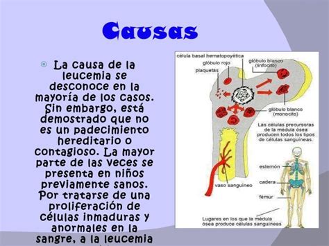 Leucemia