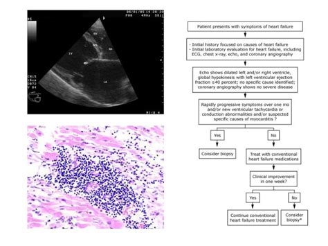 Ppt Viral Myocarditis And Dilated Cardiomyopathy Powerpoint Presentation Id 2360721