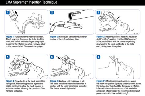 Laryngeal Mask Airway Insertion