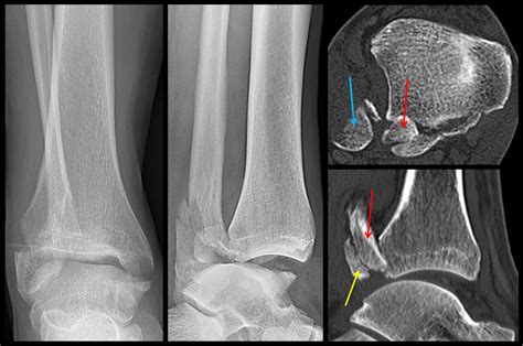 Bosworth Ankle Fracture Dislocation Current Concept Review In Efort Open Reviews Volume 9