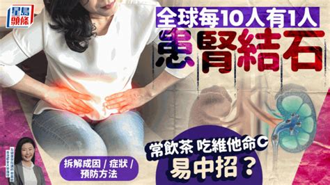 全球每10人有1人患腎結石 常飲茶吃維他命c增風險？專家拆解成因症狀 教4招預防 星島日報