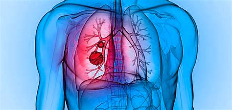 Fibrosis Quística Y Su Tratamiento En Base A La Fisioterapia Vital And Clinic