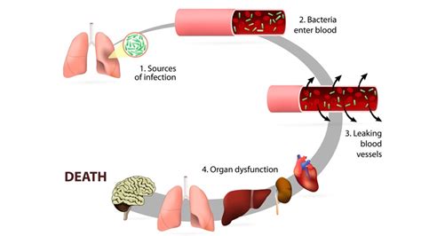 Sepsis Stages and Symptoms – Page 2 – Entirely Health