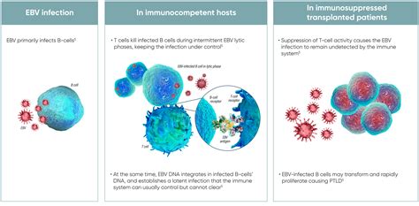 EBV PTLD Epstein Barr Virus Positive Post Transplant