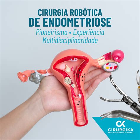 Cirurgia Rob Tica De Endometriose Cl Nica Cirurgika