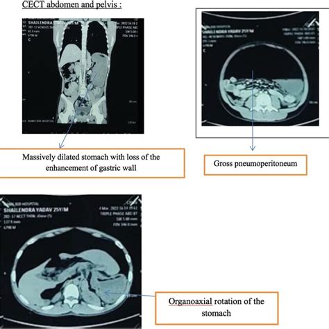 Cect Abdomen And Pelvis Showing Acute Organo‐axial Rotation Of Stomach Download Scientific