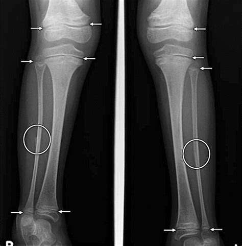 Rickets Disease X Rays