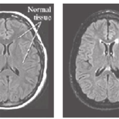 Difference Of Schizophrenia Brain And Healthy Brain Download