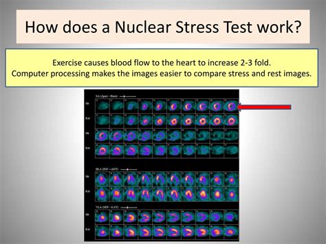 Ppt Stress Testing And Heart Disease Symptoms Powerpoint Presentation Id292366