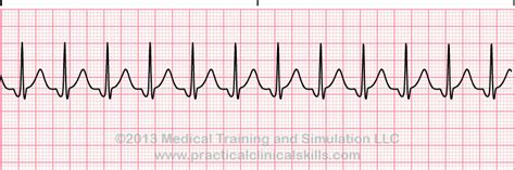 Matters Of The Heart Junctional Rhythms And Beats Patmac Rn