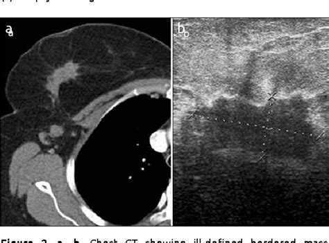 Figure From Incidental Breast Lesions Detected On Computed Thorax