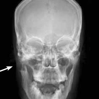 Orthopantamograph Showing Well Defi Ned Multilocular Lesion Involving