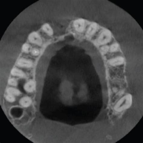 Cone Beam Computed Tomography Scans Obtained Before The Surgery Download Scientific Diagram