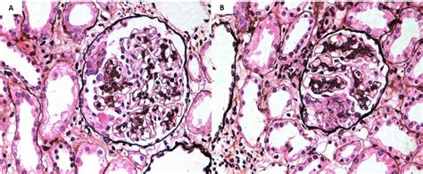 A One Glomerulus From The Renal Biopsy Of A Patient With Iga Download Scientific Diagram